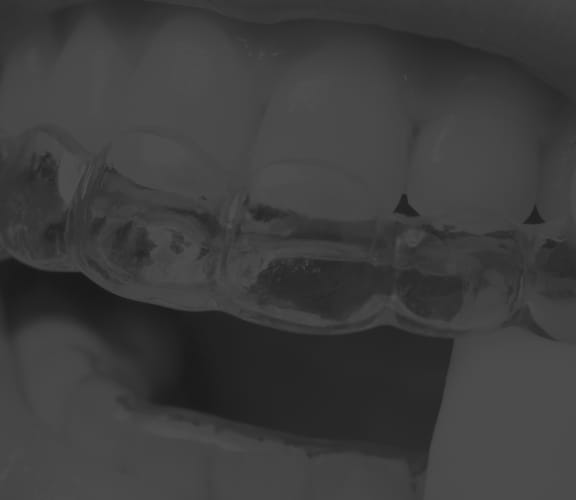 Clear aligner being put on the upper teeth