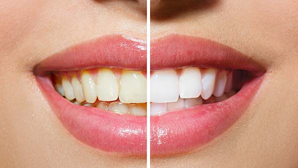 Before & After Teeth Whitening