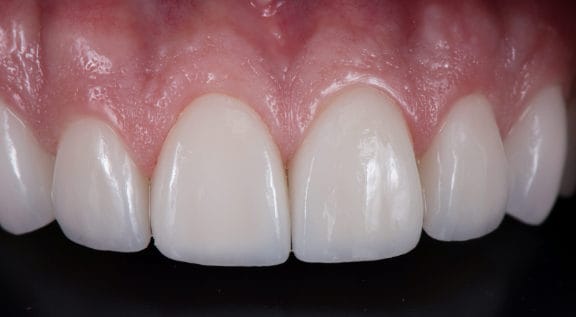 Porcelain Veneers After